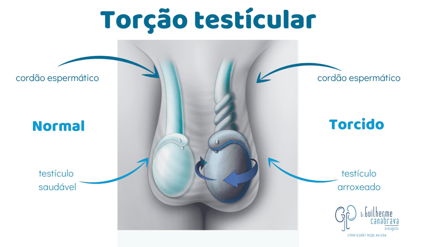 Torção testicular: 7 sinais de alerta e quando procurar um urologista ...