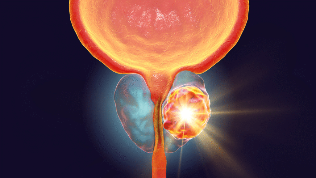 NOVEMBRO AZUL CANCER DE PROSTATA