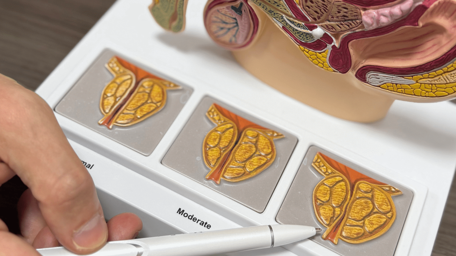 aumento da próstata