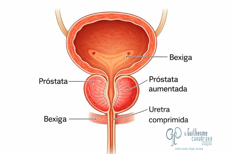próstata aumentada comprimindo a uretra