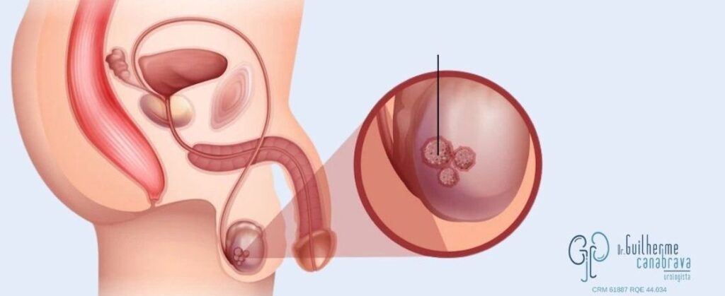 destaque-cancer-de-testiculo