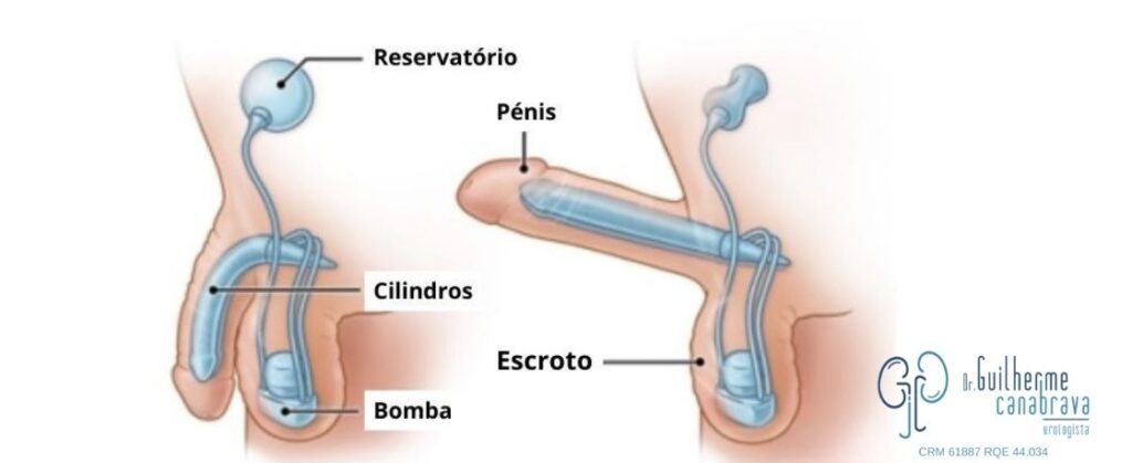 o que é a protese peniana
