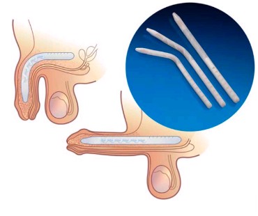 protese peniana semirrigida