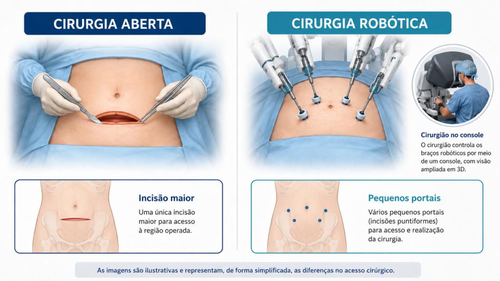 comparação entre cistectomia aberta e cistectomia robótica