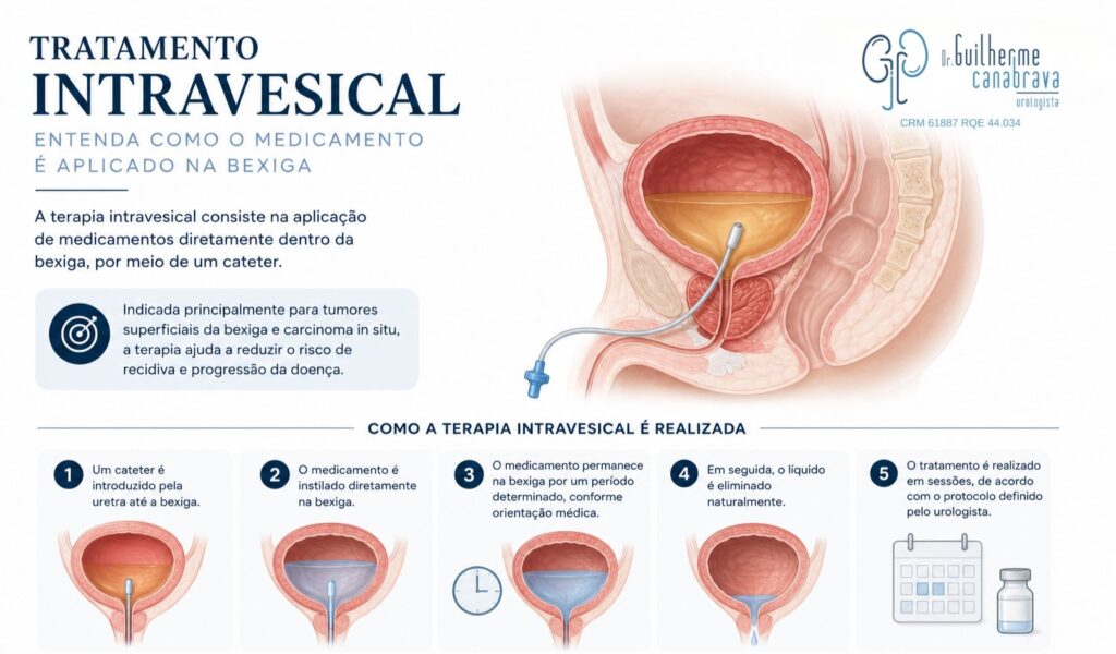 BCG intravesical no tratamento de tumores superficiais de bexiga de alto risco