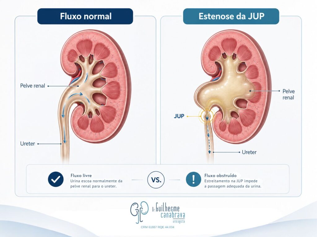 Comparação entre fluxo urinário normal e estenose da junção ureteropiélica