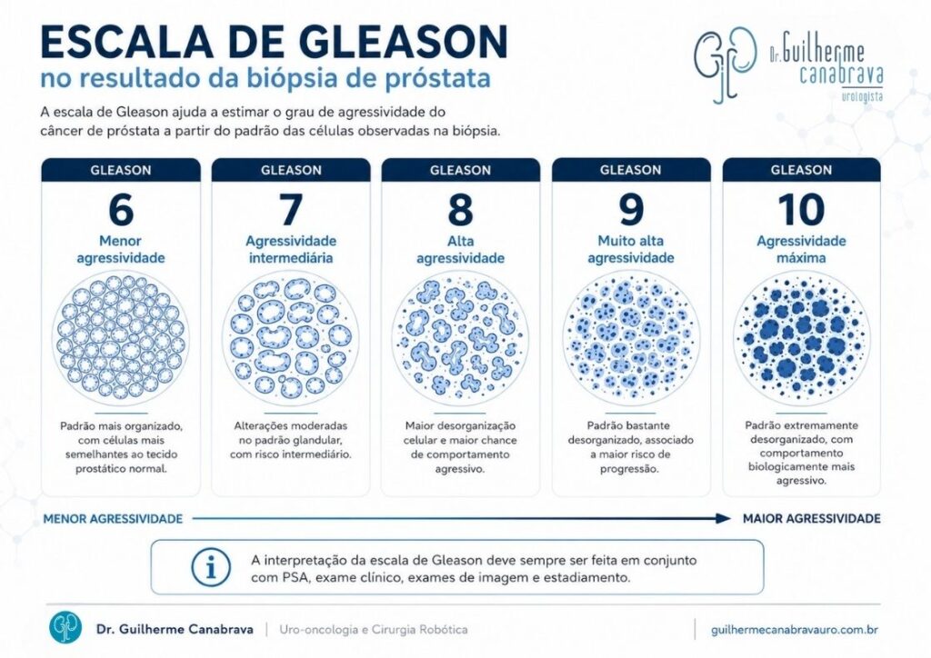 escala de Gleason no resultado da biópsia de próstata