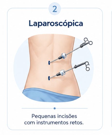 Pieloplastia laparoscópica