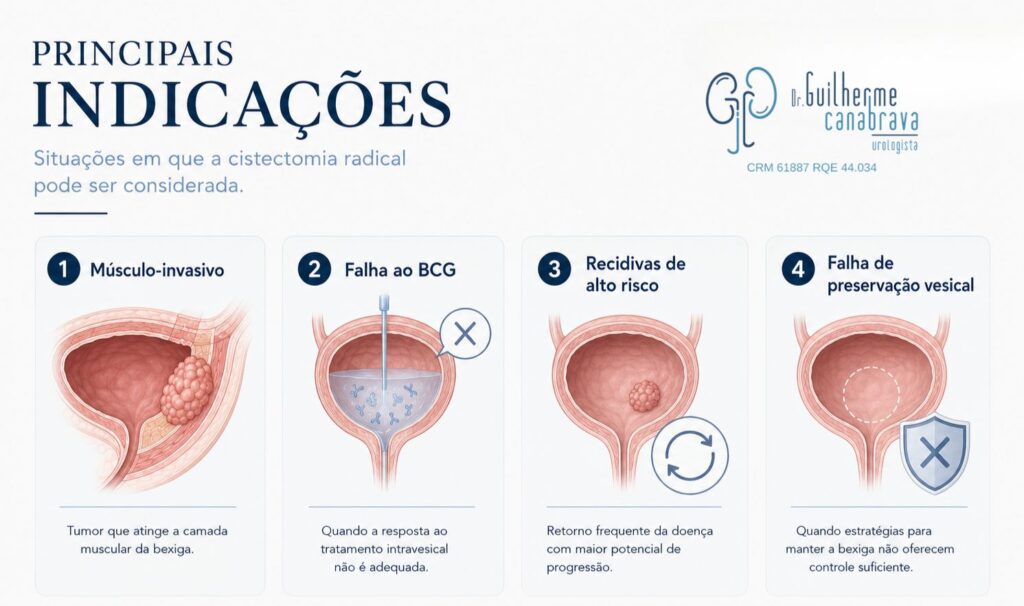 principais indicações da cistectomia radical no câncer de bexiga