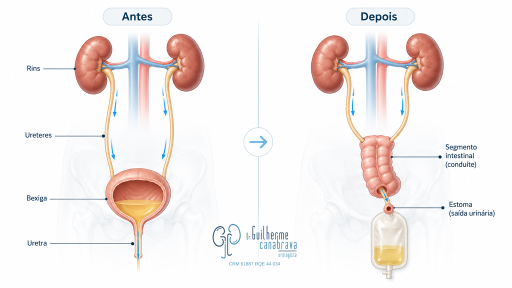 Comparação do caminho da urina antes e depois da cistectomia com reconstrução urinária